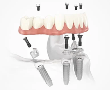 All-On-4 Implant System | RivaDent