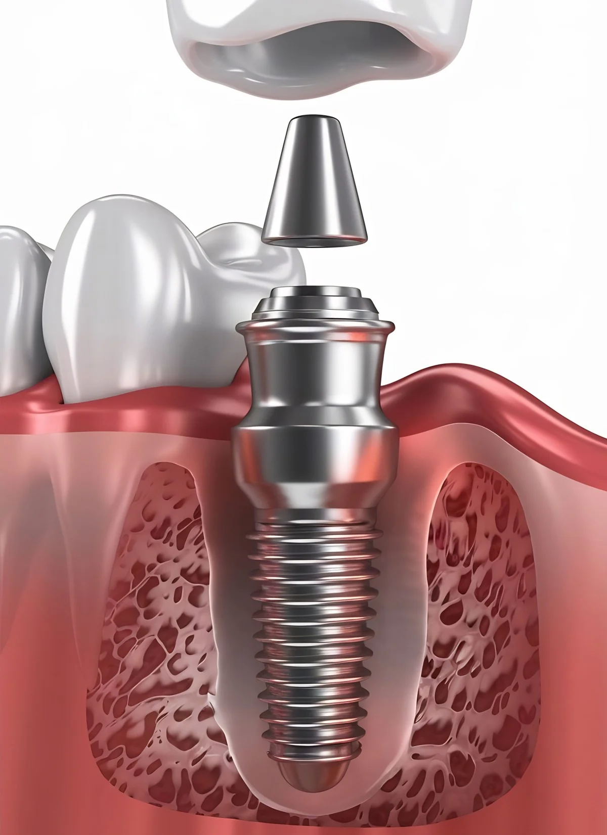 Rivadent Dental Implant Treatment
