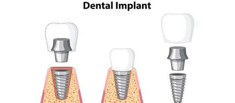 Additional Treatments Supporting Dental Implant Treatment | RivaDent