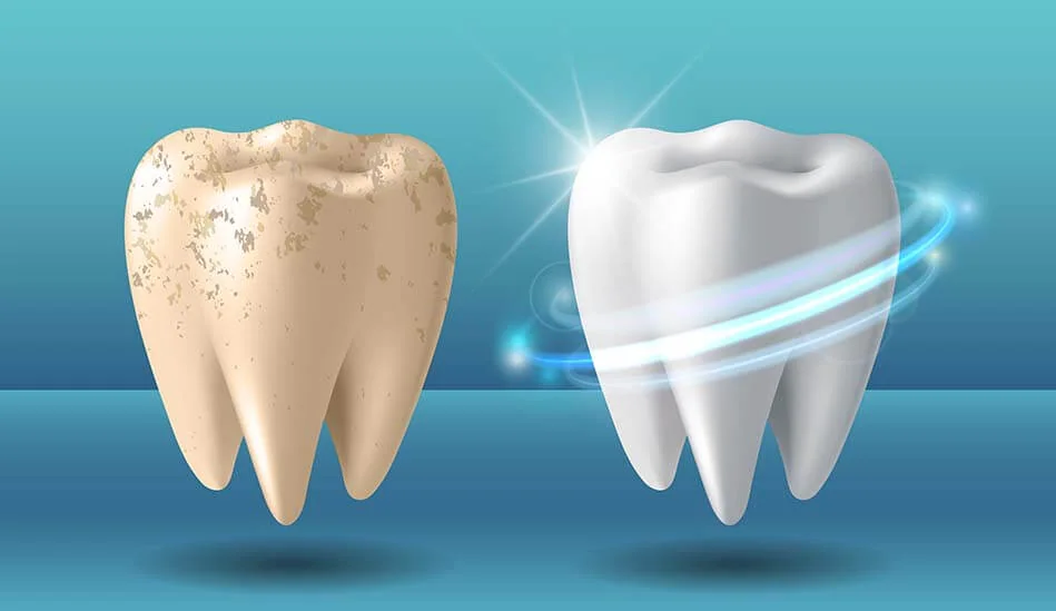 Teeth Whitening (Bleaching) Methods | RivaDent