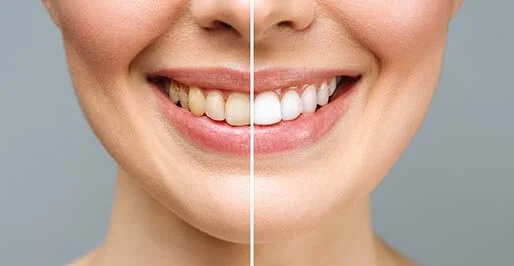 Teeth Whitening (Bleaching) Methods | RivaDent