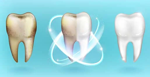 Teeth Whitening (Bleaching) Methods | RivaDent