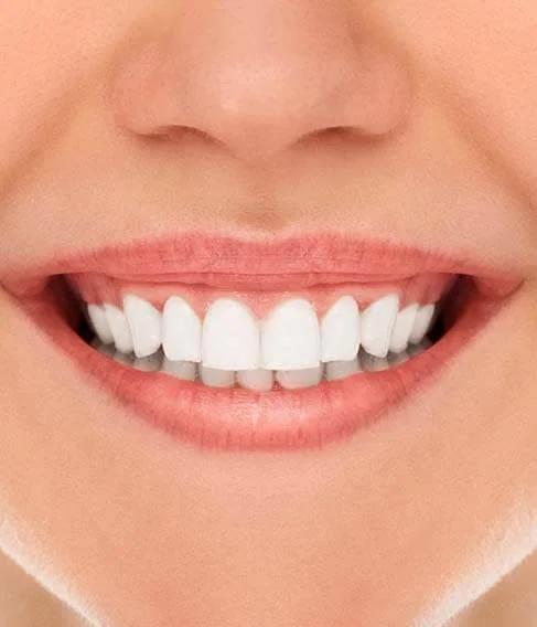 What is Teeth Whitening? | RivaDent