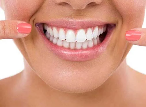 Teeth Whitening | RivaDent