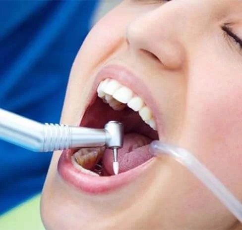 Tooth Decay Treatment