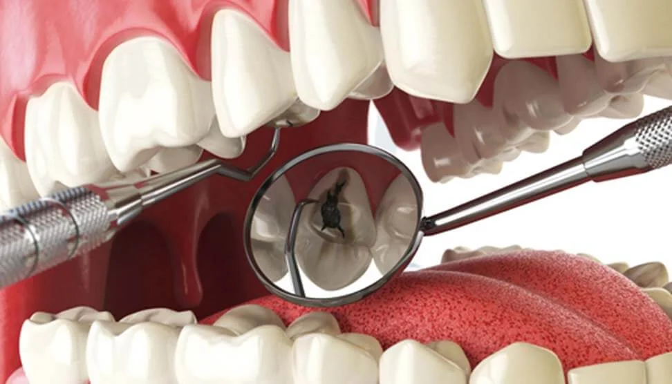 Tooth Decay