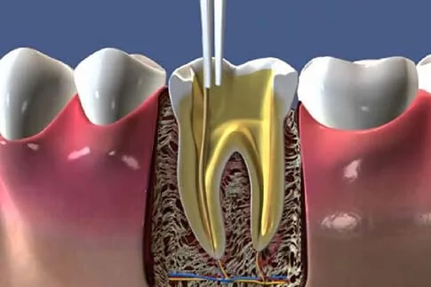 Stages of Endodontic Treatment | RivaDent