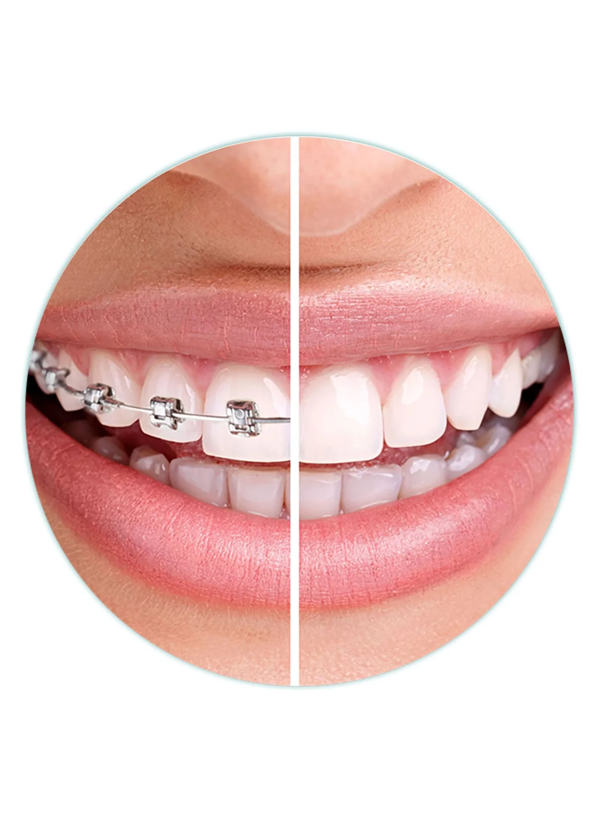 Orthodontic Treatment | RivaDent