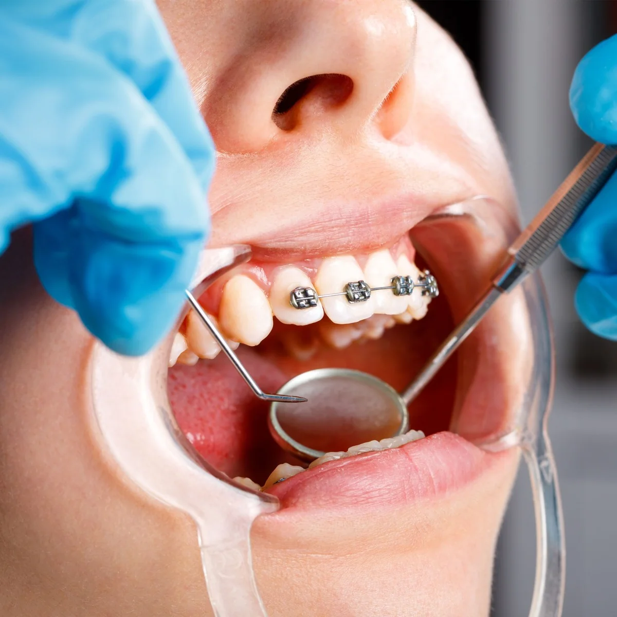 Is There an Age Limit for Orthodontic Treatment? | RivaDent