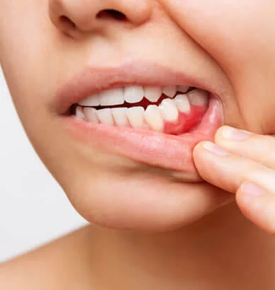 Periodontal Hastalıkların Belirtileri | RivaDent