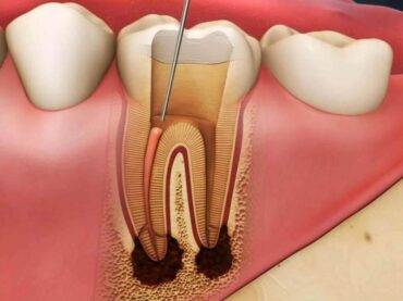 Endodonti (Kanal Tedavisi)