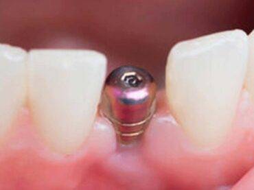 Dental İmplant